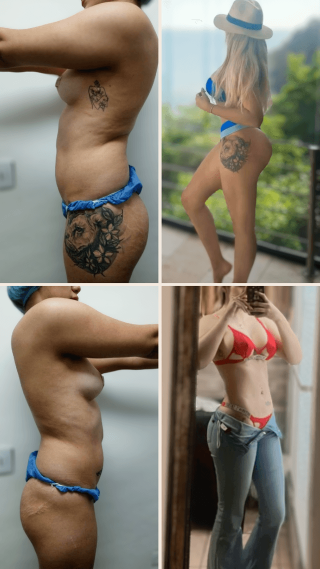 Cirugia Plastica Medellin